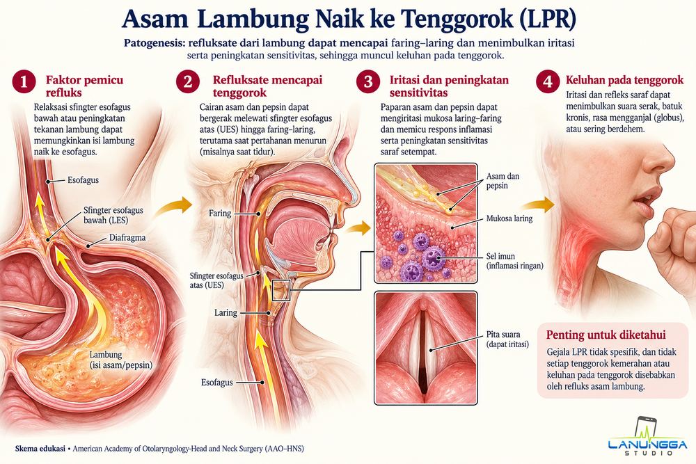Asam Lambung Naik ke Tenggorok (LPR)