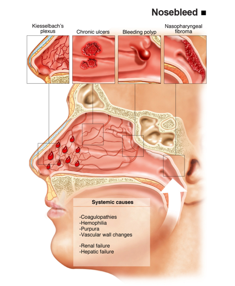 Epistaksis (Mimisan)