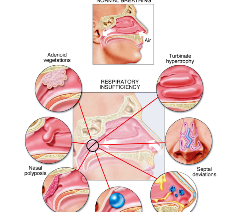 Hidung Mampet Kronis: Bedakan Alergi, Polip, atau Septum