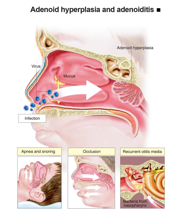 Adenoid Hipertrofi