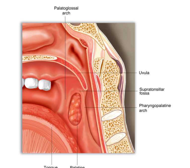 Tonsil Stones (Tonsilolith): Penyebab Bau Mulut Persisten