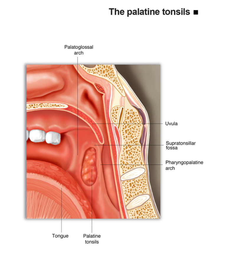 Tonsil Stones