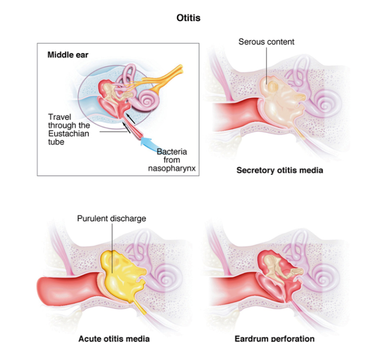 Otitis Media Efusi (Glue Ear): Cairan di Telinga Tengah