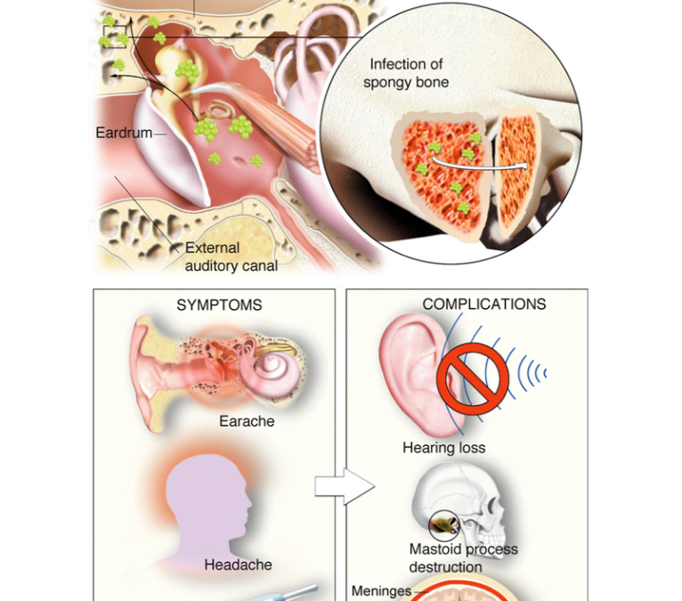 Mastoiditis: Komplikasi Otitis yang Berbahaya