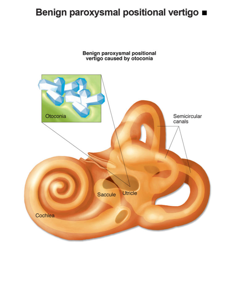 Vertigo & Keseimbangan