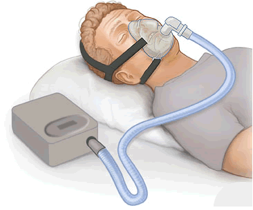 CPAP: Cara Kerja dan Tips Adaptasi Pemakaian
