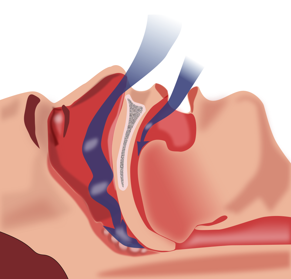 Sleep Position untuk Sleep Apnea: Tips Tidur Sehat